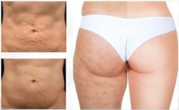 Carboxiterapia