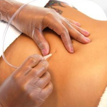 Carboxiterapia