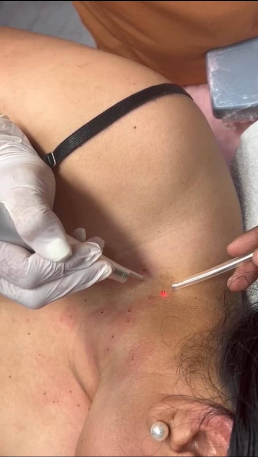Imagen de Cauterización laser