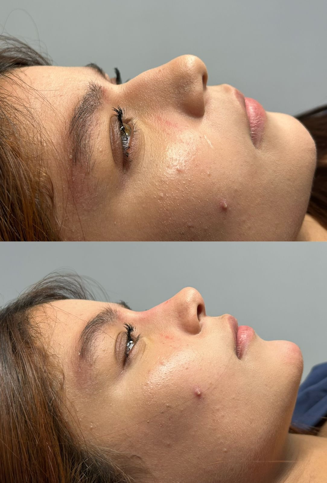 Imagen de rinomodelación