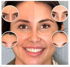 botox